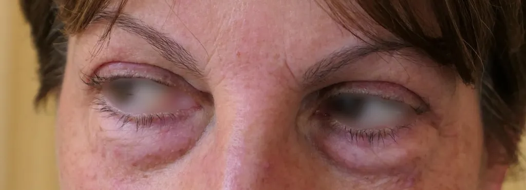 Blepharoplasty in France: rejuvenating and brightening the eyes with Dr Jean-François Pascal in Lyon