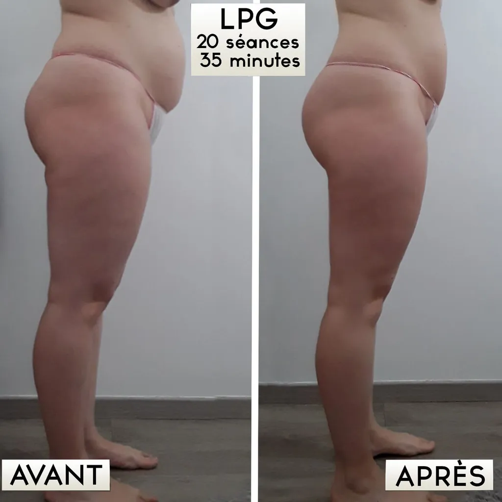 LPG ventre plat silhouette et drainage à Toulouse