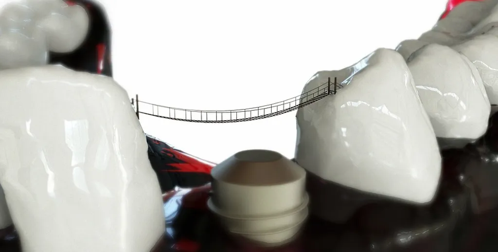 Technique de Mise en Charge Immédiate des implants spécialiste implantation complète à Gignac