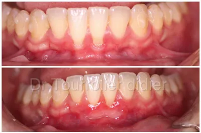 Greffe d egencive marseille parodontologie