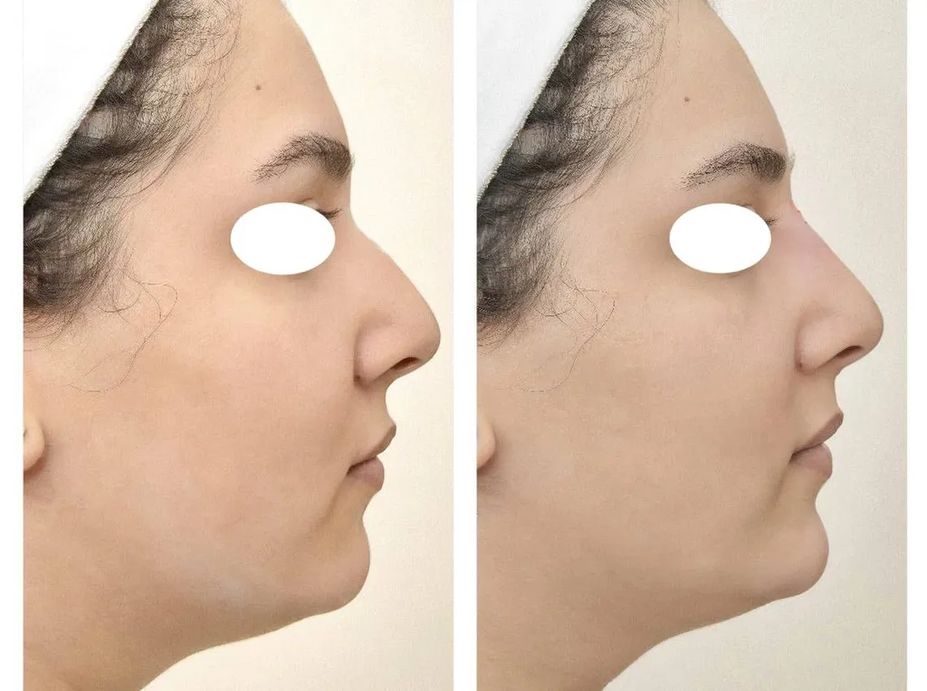 Acide hyaluronique Profile profiloplastie nez menton 