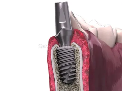 Comment cacher une dent manquante?  Dr Tourrolier didier .Marseille .13005