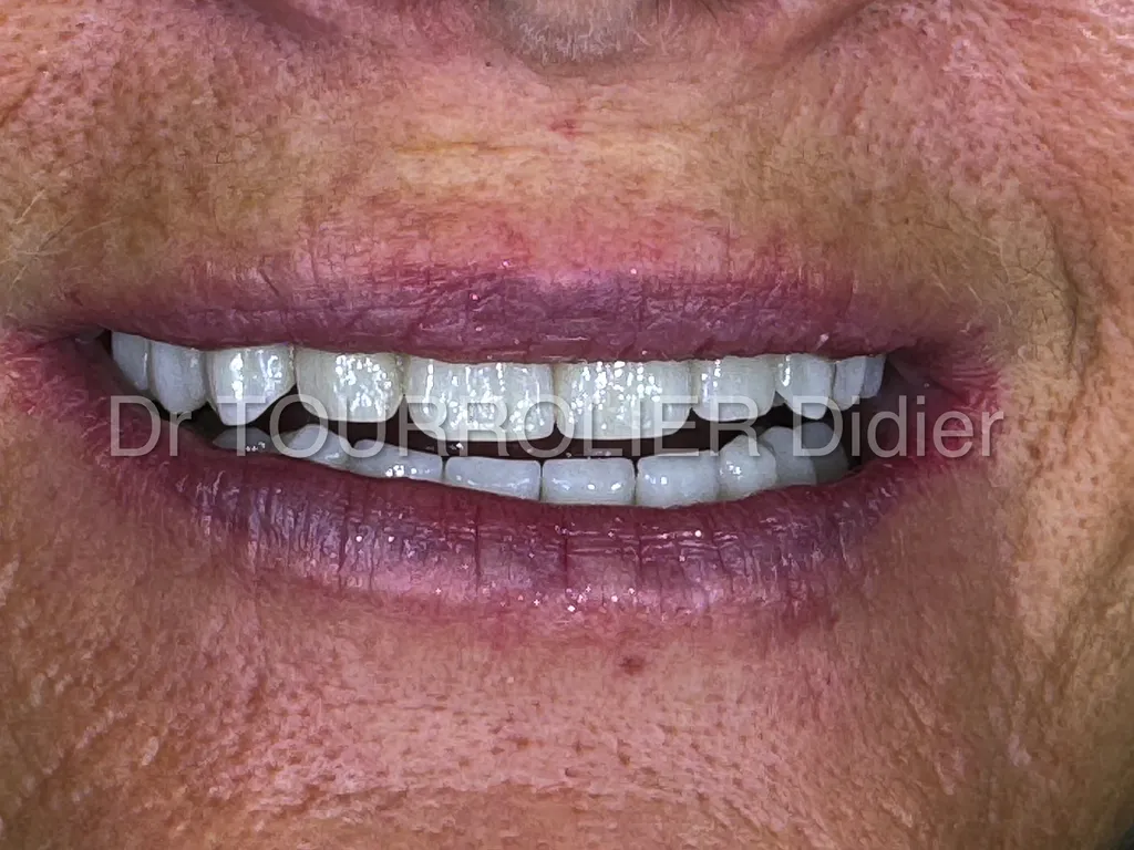 all-on-4-marseille-prothese-fixe-implants-dr-tourrolier