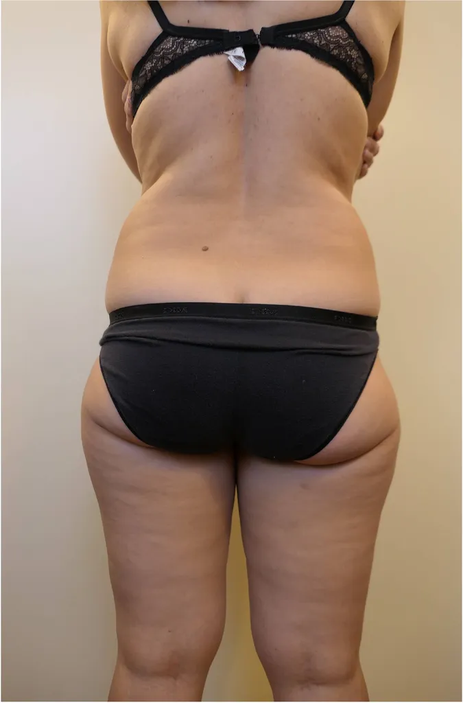 Traitement du lipœdème à Lyon – Liposuccion chirurgicale avancée par un chirurgien esthétique expert