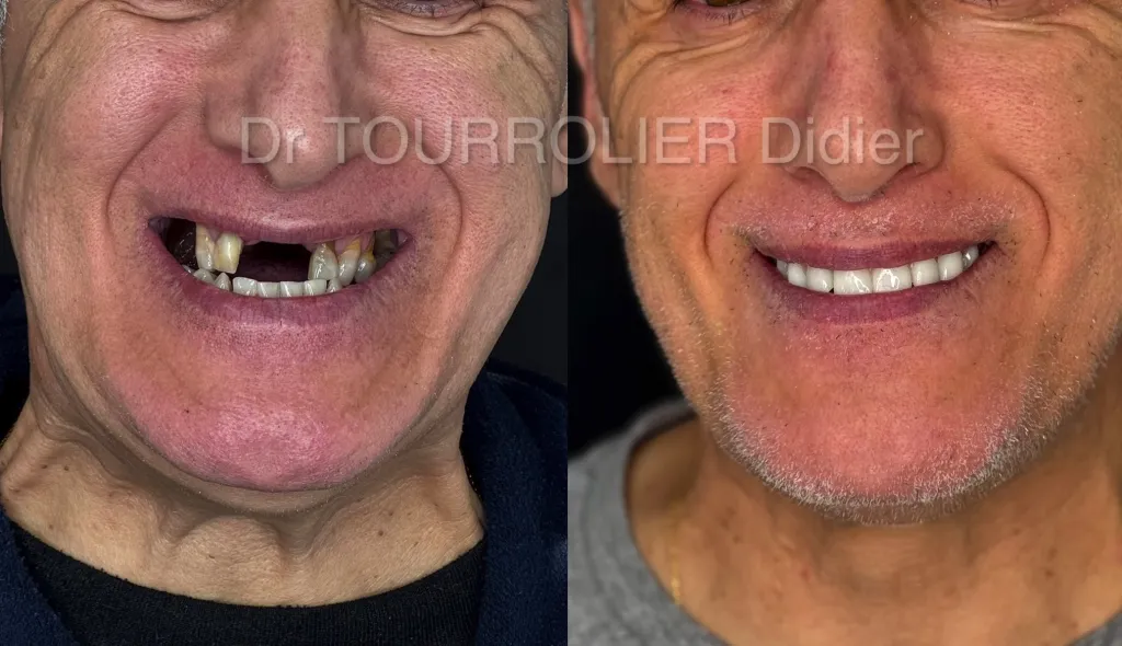 Notre zone d'activité pour ce serviceDentiste pour pose d'implant Nobel