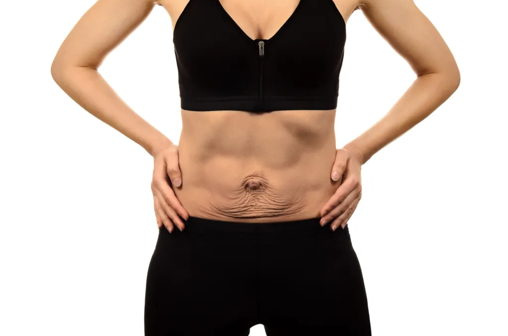 J’ai perdu beaucoup de kilos : au centre expert esthétique DERMA SUD Castanet-Tolosan, raffermir ventre, bras et cuisses grâce à la radiofréquence INDIBA® après une perte de poids
