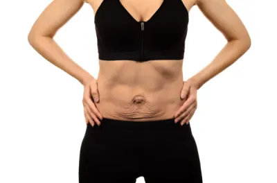 J’ai perdu beaucoup de kilos : au centre expert esthétique DERMA SUD Castanet-Tolosan, raffermir ventre, bras et cuisses grâce à la radiofréquence INDIBA® après une perte de poids