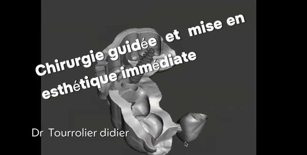 Notre zone d'activité pour ce serviceDentiste pour pose d'implant Nobel