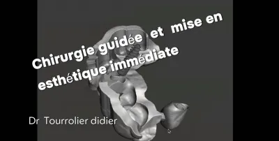 specialiste chrirugie implant dentaire guidée mise en esthétique immédiate 
