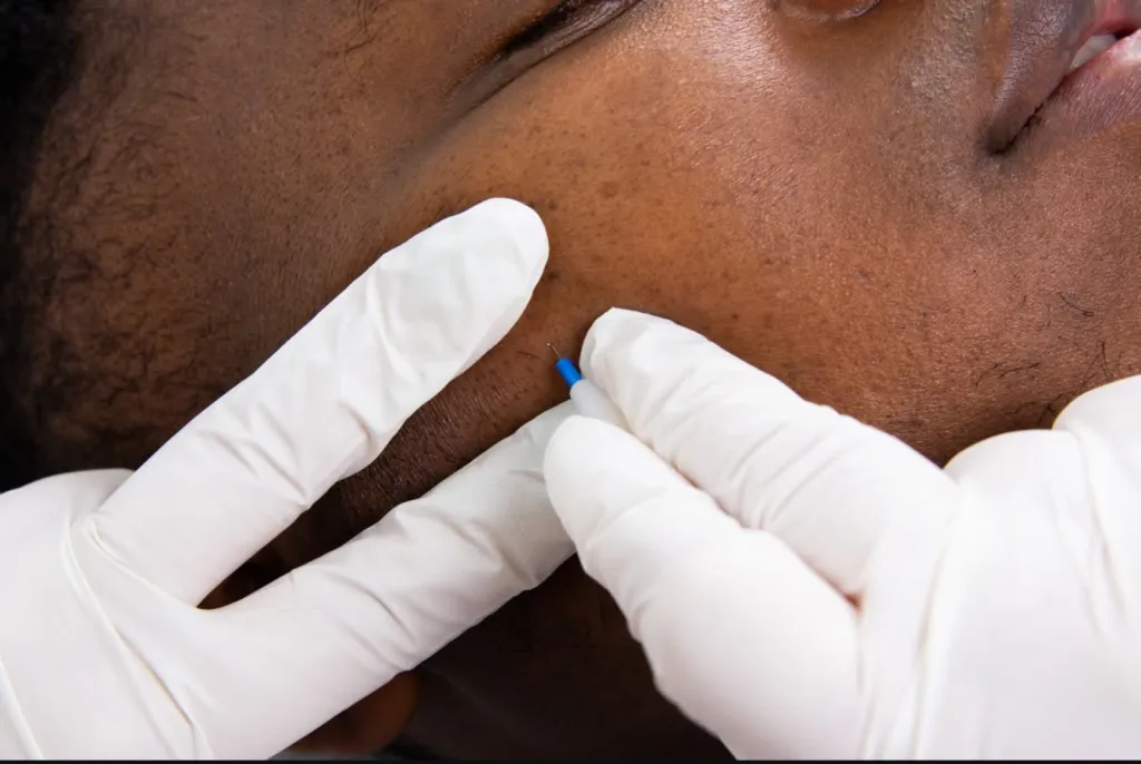 Électrolyse à Toulouse