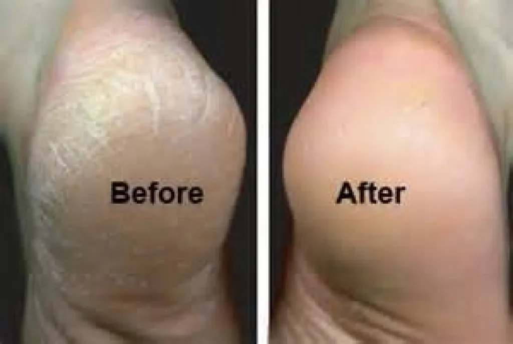 avant/après Callus peeling