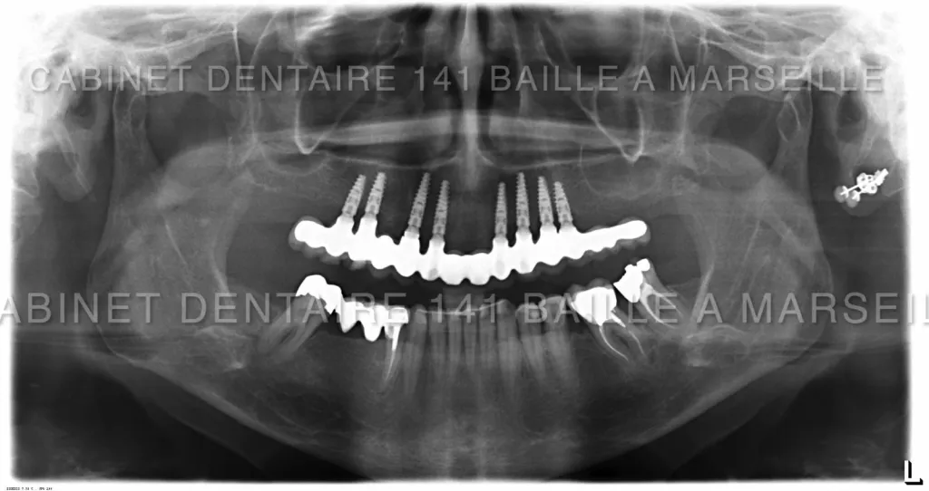 Spécialiste implantation arcade dentaire complete