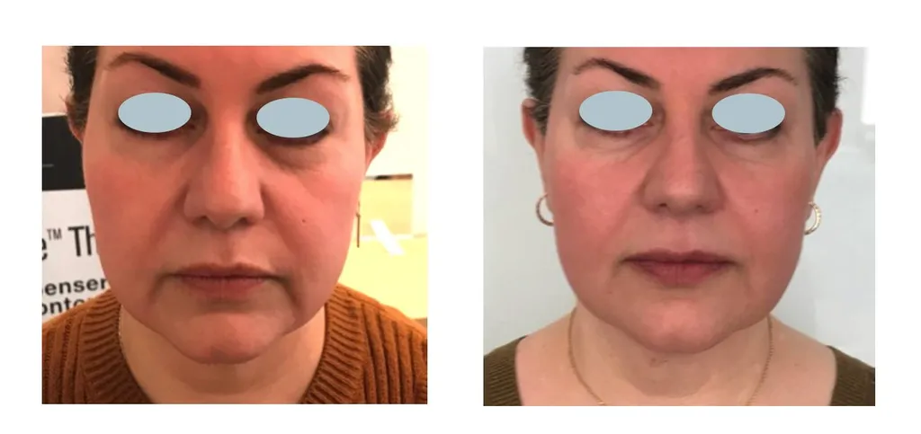 fils tenseurs Paris, relâchement médecine esthétique  