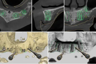 spécialiste implantologie dentaire Marseille