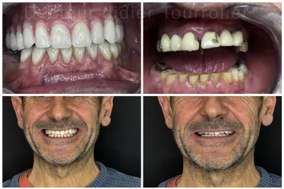 Spécialiste All on 6 France