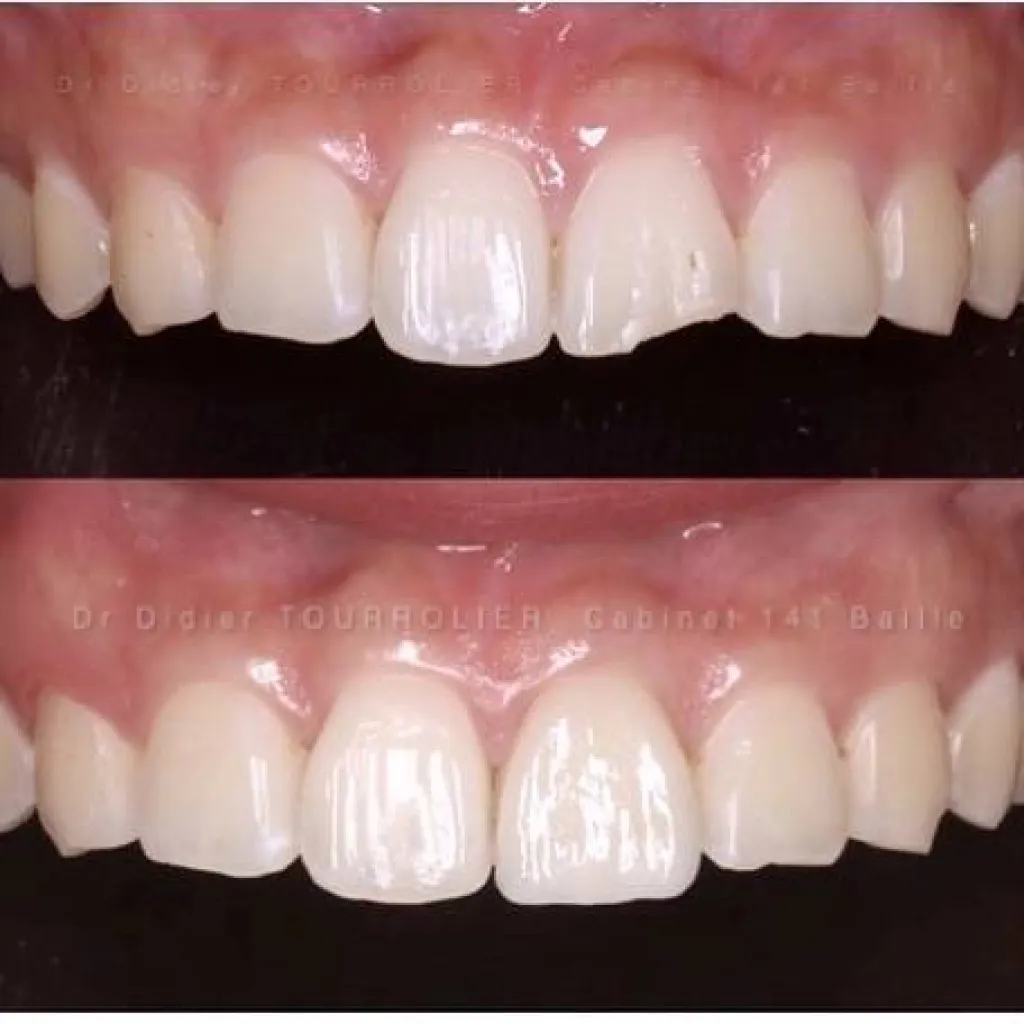 spécialiste dans la pose de facettes dentaires à Marseille