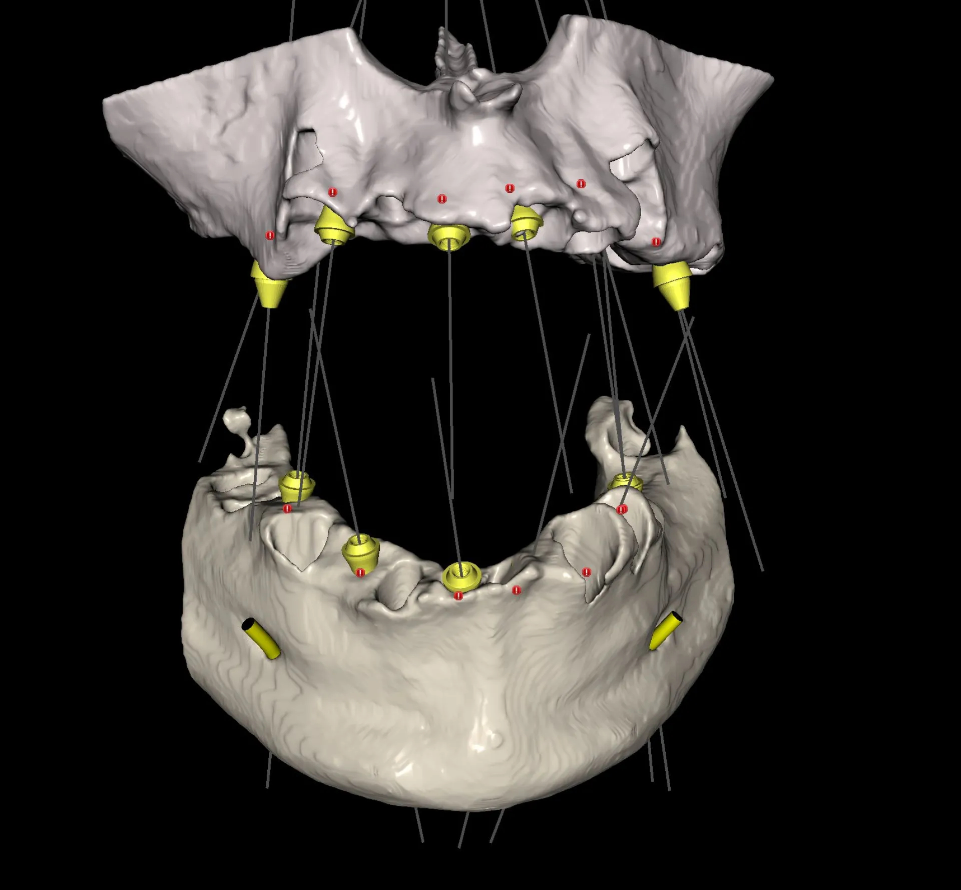 specialiste chirurgie implantaire guidée marseille et france
