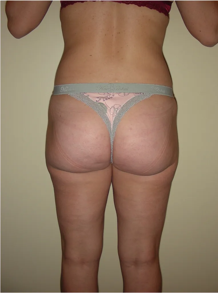 Buttock Lift & Augmentation – Top aesthetic surgeon in Lyon, France for natural curves