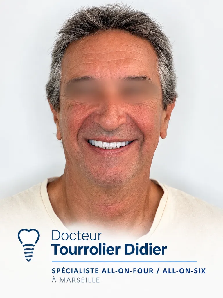 Dr Didier Tourrolier Implantologie – All-on-4 & All-on-6 à Marseille