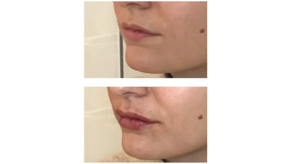 Remodelage des lèvres par injection d'acide hyaluronique à Paris