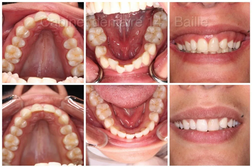 traitement invisalign du souire gingival