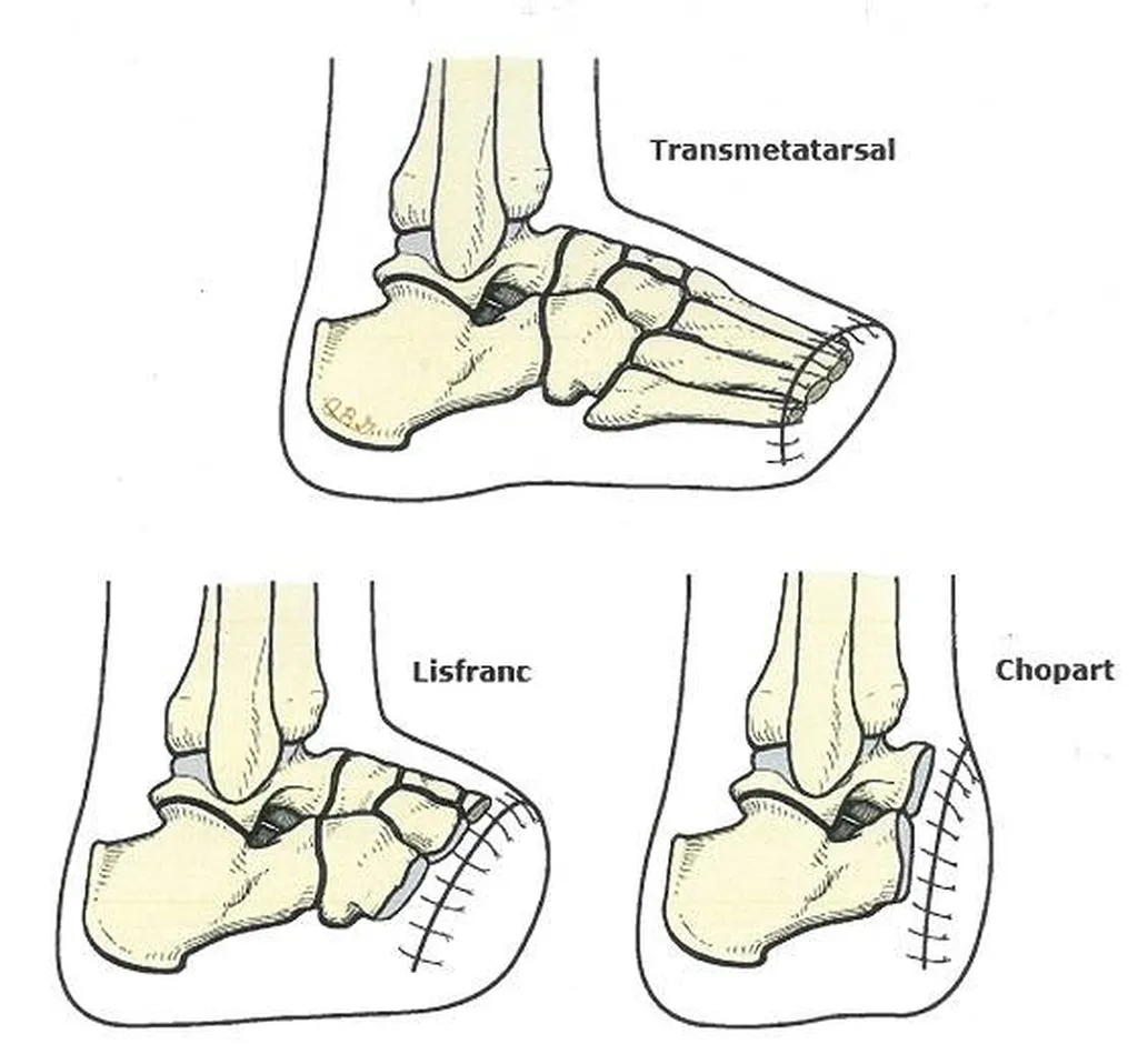 des solutions pour l'appareillage du pied amputé