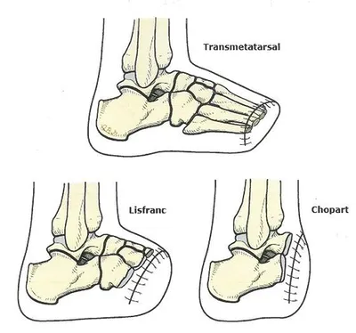 des solutions pour l'appareillage du pied amputé
