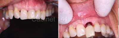 Implant dentaire pour une dent tout de suite Marseille