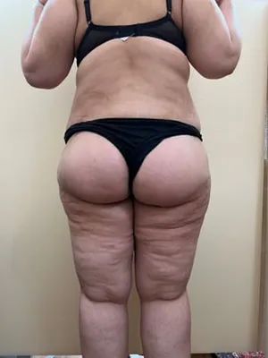 Lower body lift in France: advanced post-weight loss surgery with Dr Jean-François Pascal in Lyon