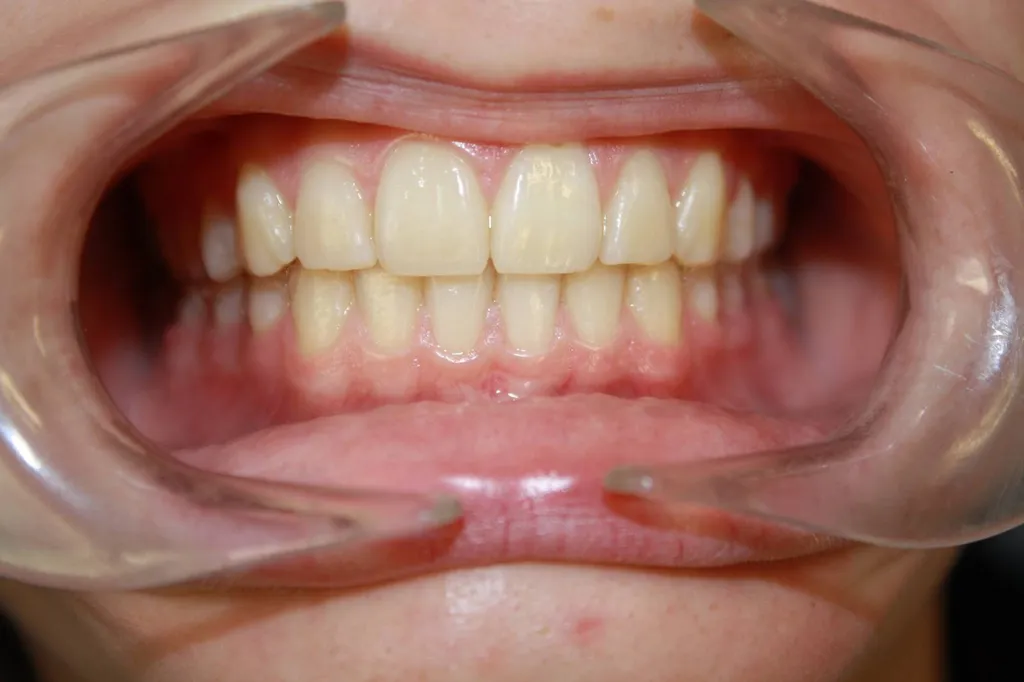 orthodontie invisalign marseille 