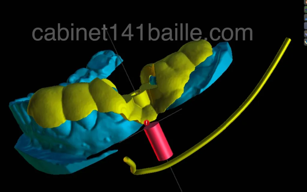 Guide chirurgical implantaire Marseille