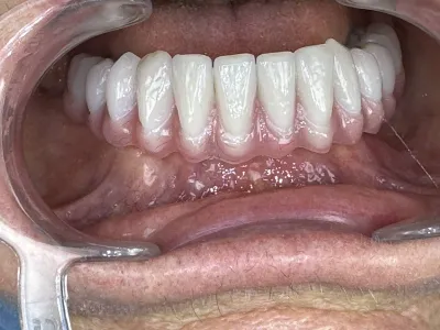 Specialiste all on 4 et All on 6 Marseille