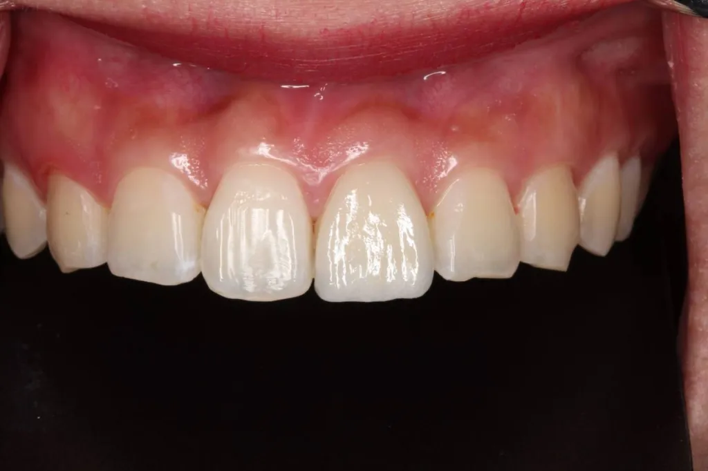 Tarif pour facettes dentaires sur Marseille