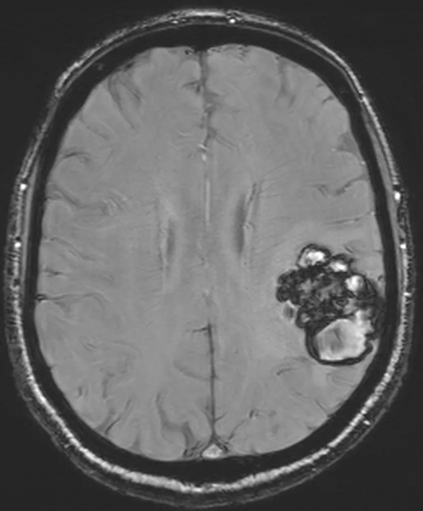 Cavernome parietal gauche