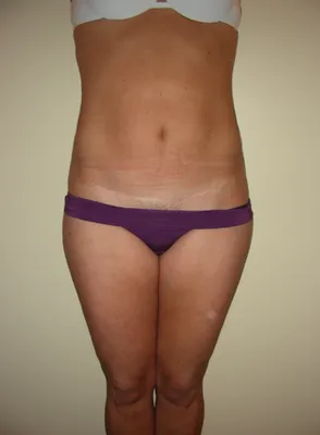 Plastie abdominale : Une réparation du ventre