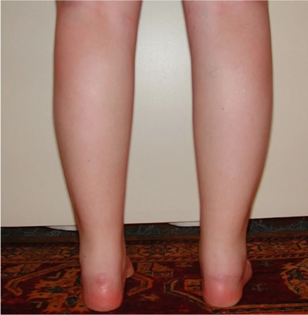 Lipoedema treatment in France: surgical expertise of Dr Jean-François Pascal in Lyon