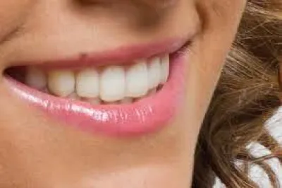 Facettes Lumineers Marseille-Docteur TOURROLIER Didier.13005.