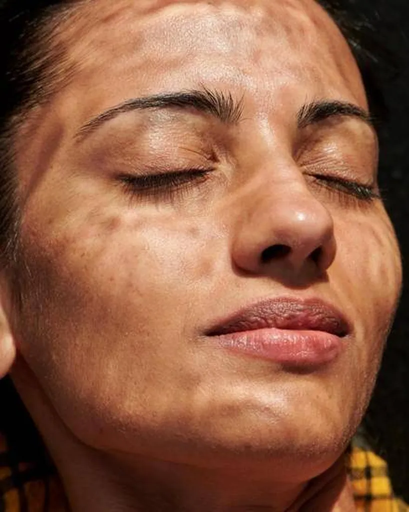 Notre zone d'activité pour ce serviceTarif jawline contouring à l'acide hyaluronique