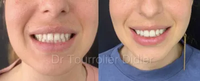 spécialiste facettes dentaires 