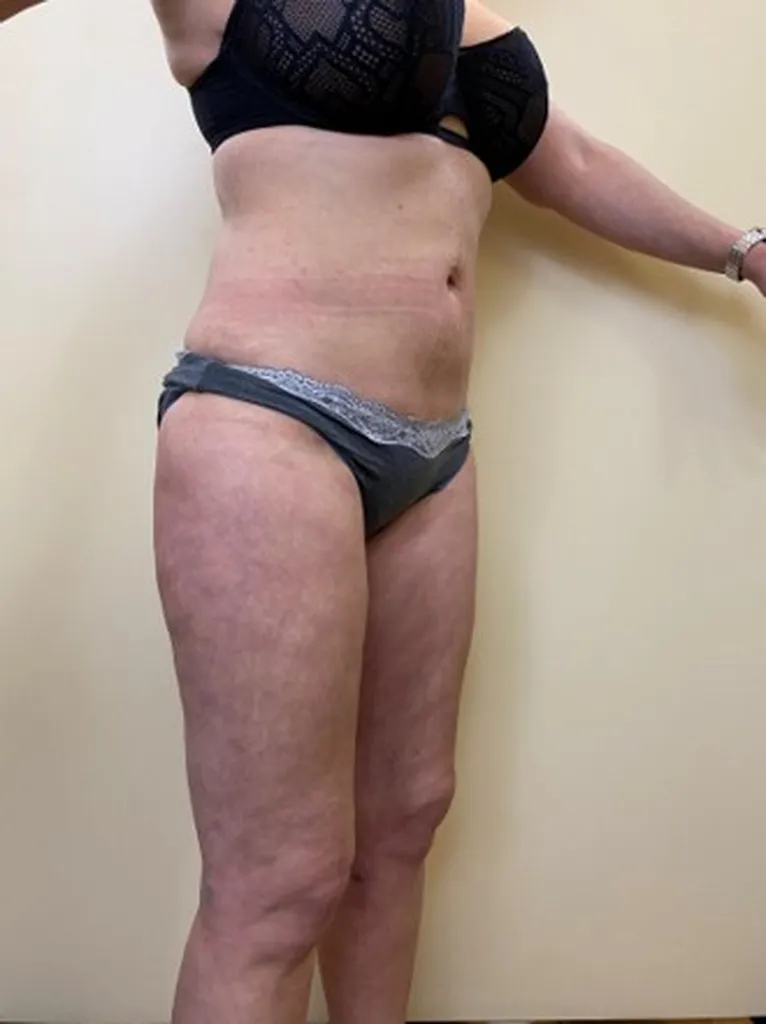 Dr Jean-François Pascal - Pose de prothèses mammaires anatomiques pour poitrine plate à Nice dans les Alpes-Maritimes