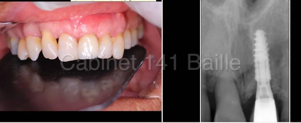 Spécialiste implant dentaire marseille
