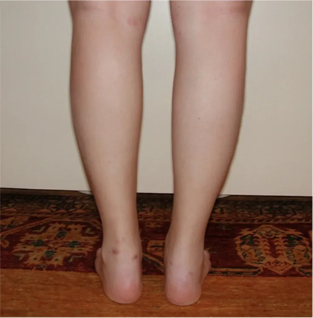 Lipoedema treatment in France: surgical expertise of Dr Jean-François Pascal in Lyon