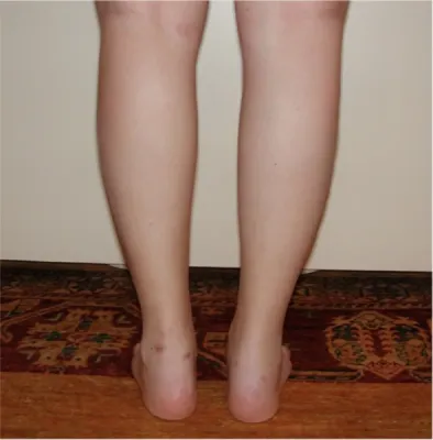 Lipoedema treatment in France: surgical expertise of Dr Jean-François Pascal in Lyon