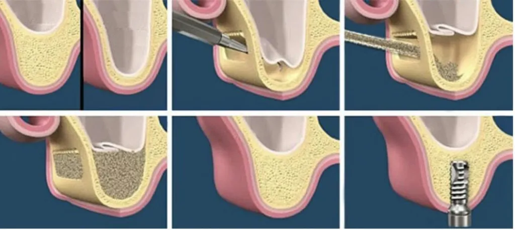 Greffe de sinus à Marseille 13005