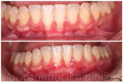 specialiste greffe de gencive Marseille