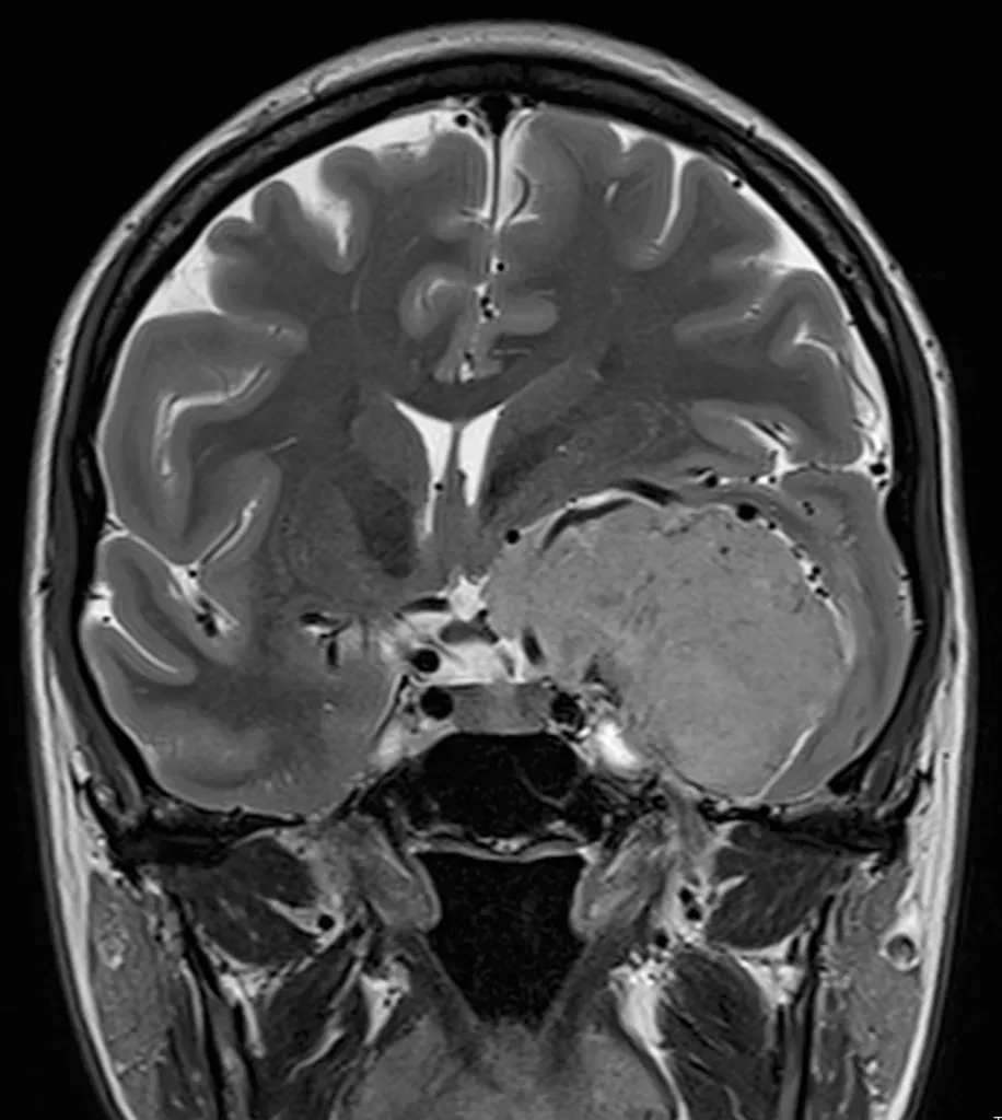 Méningiome de la base du crâne inséré sur l'apophyse clinoïde antérieure