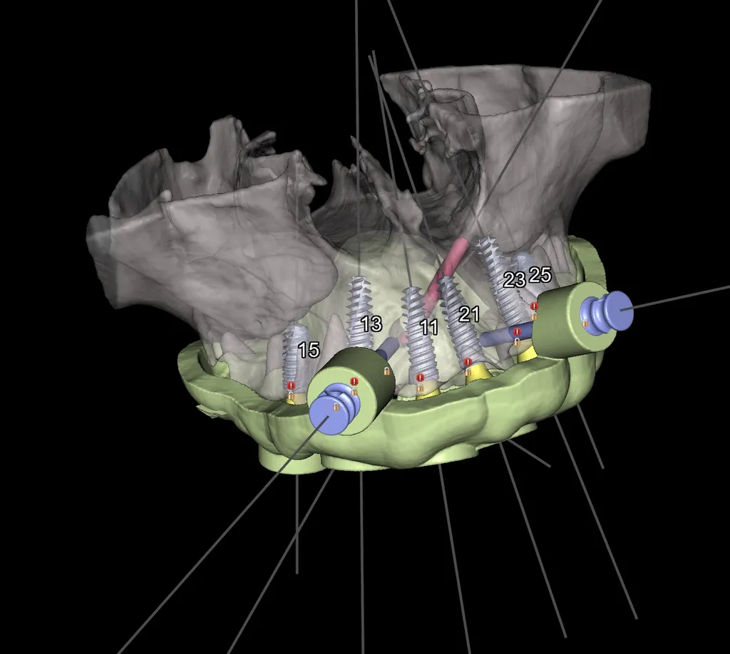 Guide chirurgical imprimé en 3D pour pose d’implant dentaire.Dr Tourrolier didier