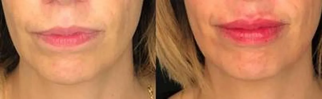 lèvres EGOLIPS acide hyaluronique profhilo