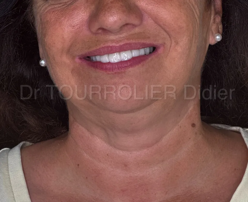 Mise en charge immédiate des implants à Marseille par specialiste en implantologie