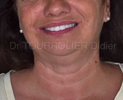 Mise en charge immédiate des implants à Marseille par specialiste en implantologie